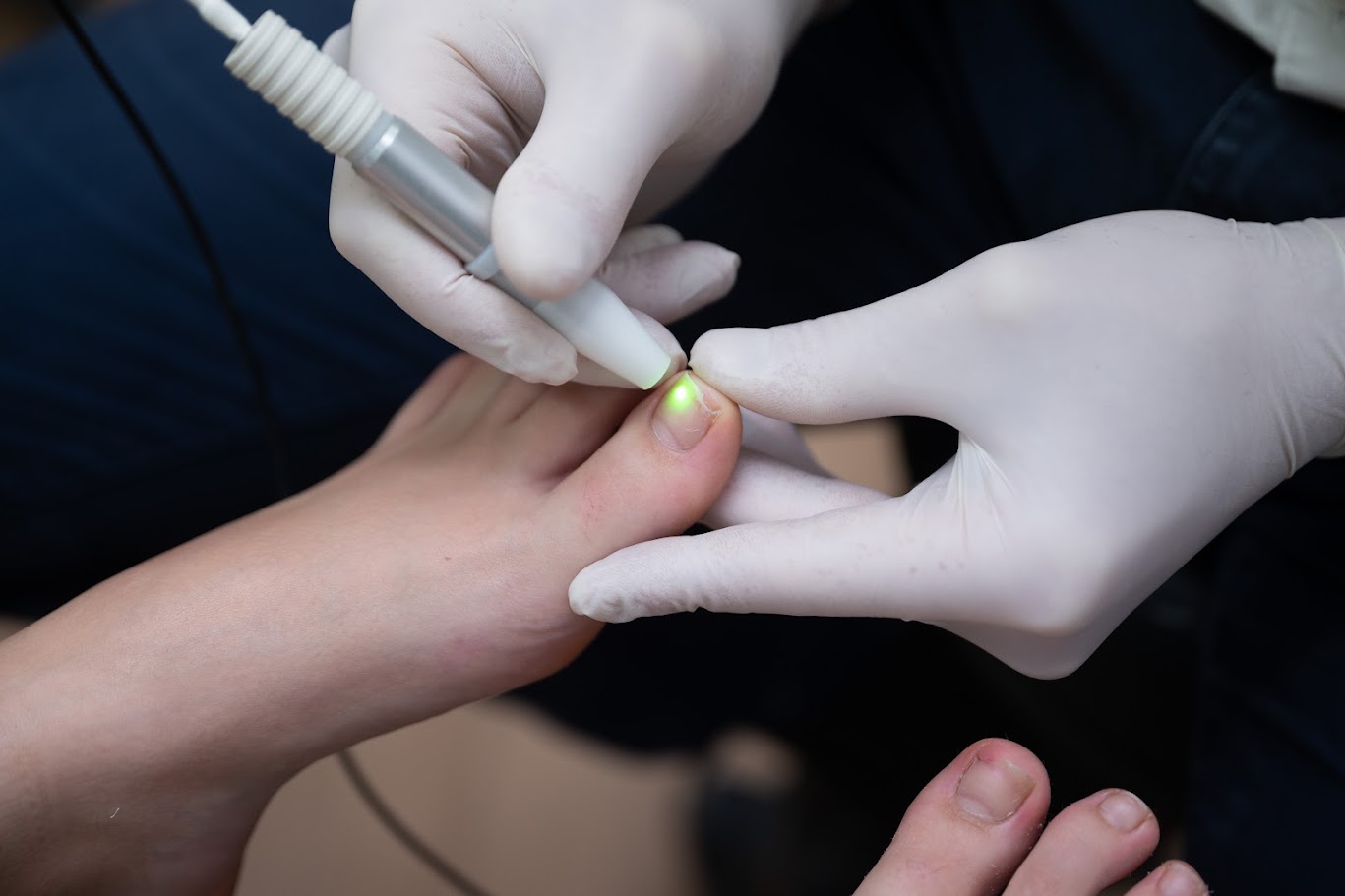 Laser for fungal infections